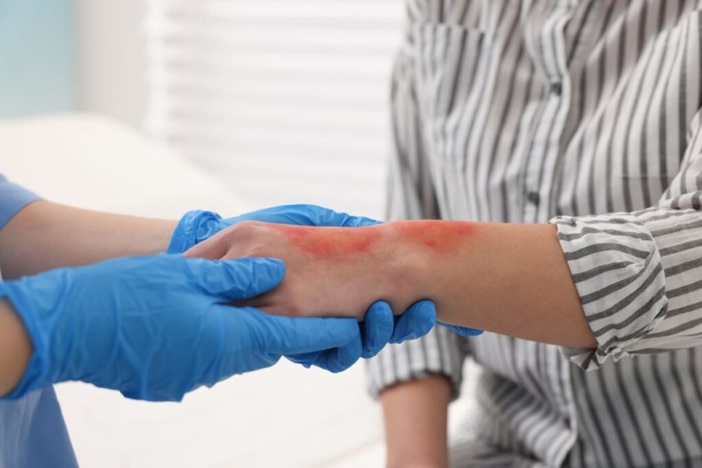 burn injuries