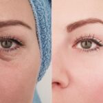 tear trough filler