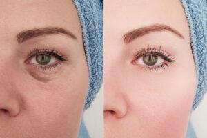 tear trough filler