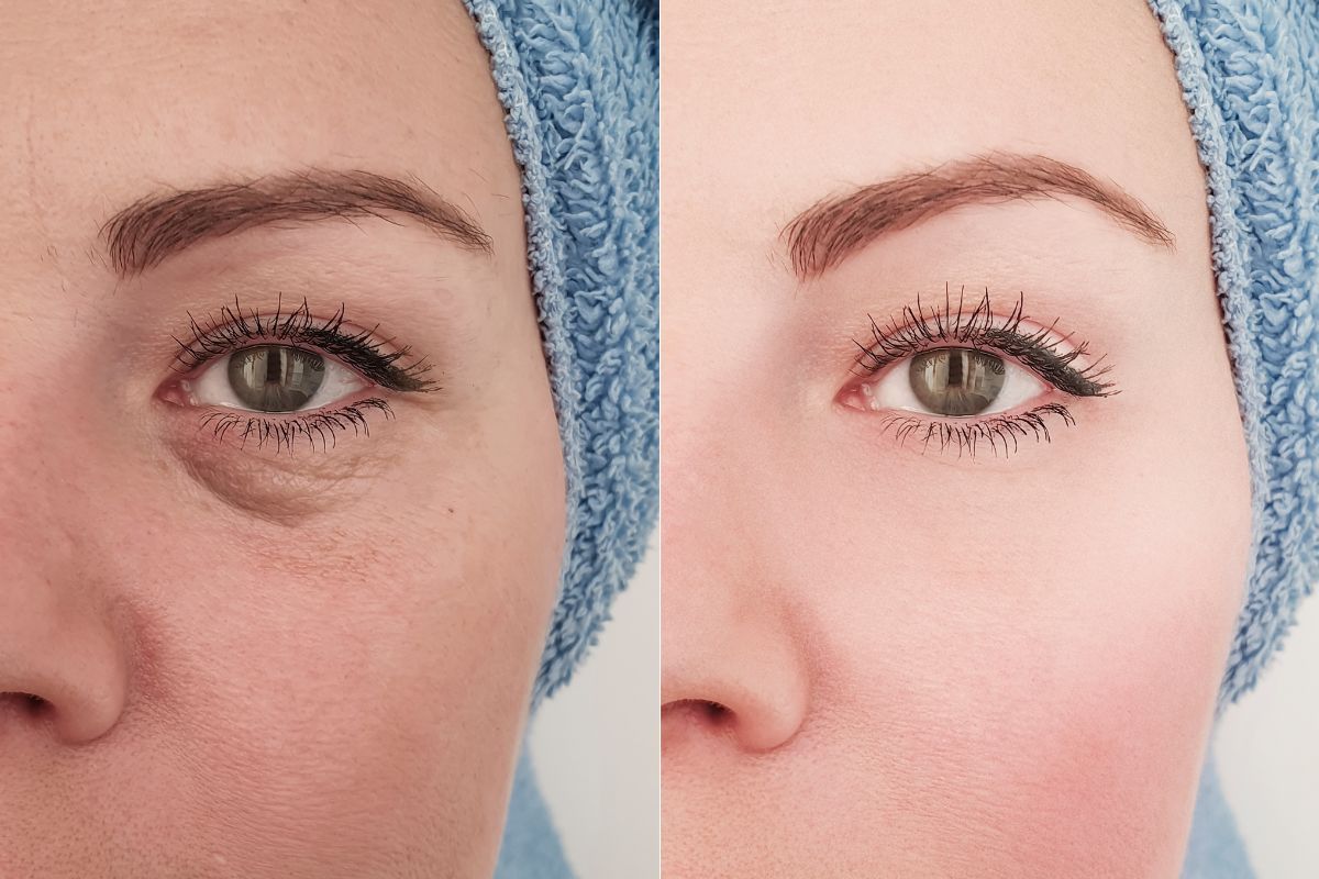 tear trough filler