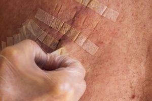 How Long to Keep on Steri Strips