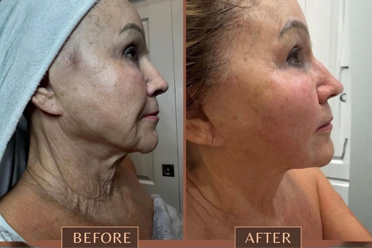 xerf skin tightening before and after